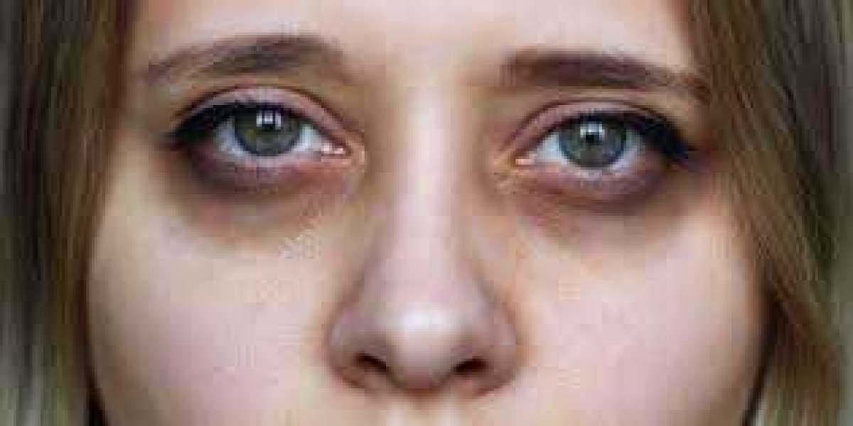 Umfassender Leitfaden zur Entfernung von Tränensäcken und Augenringen in Zürich