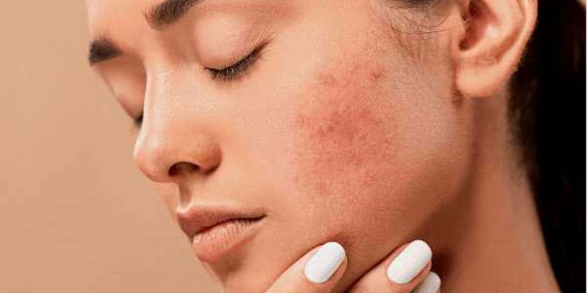 The Emotional Impact of Skin Problems