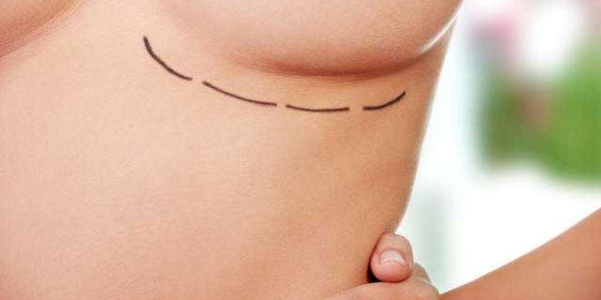 Step-by-Step Guide to Planning Your Breast Lift in Dubai