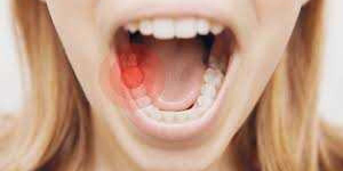 Unleashing the Power of Brufen 200 mg: A Game-Changer for Dental Pain, Neuralgia, and Migraine Management