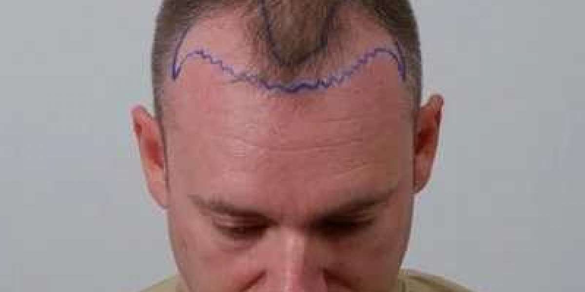 Is Hair Transplant Painful?