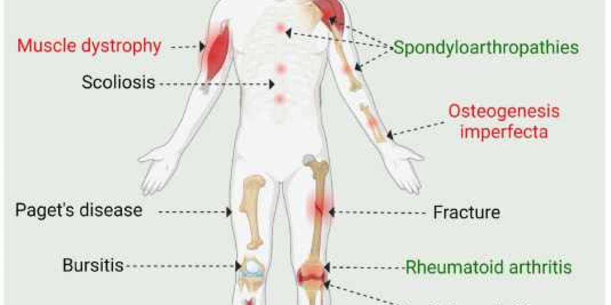 Pain O Soma 500 mg: A Solution for Skeletal Muscle Diseases Involving Rigidity and Inflammation