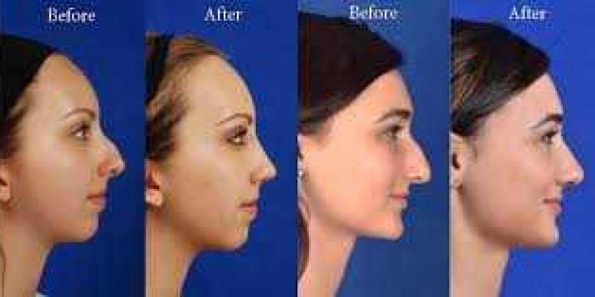 The Ultimate Guide to Rhinoplasty in NYC: What You Need to Know