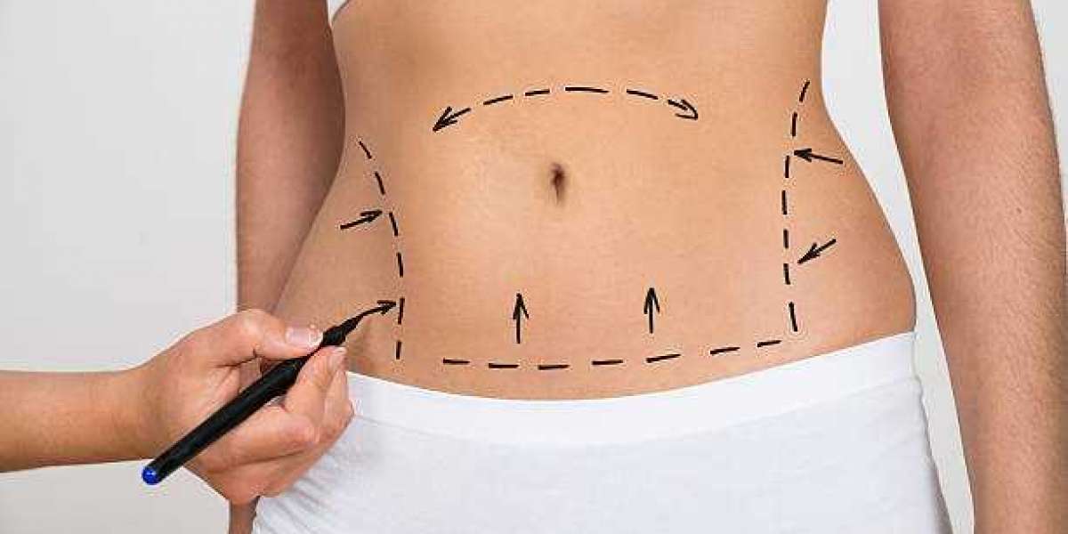 "Understanding Liposuction: A Path to a More Sculpted You"